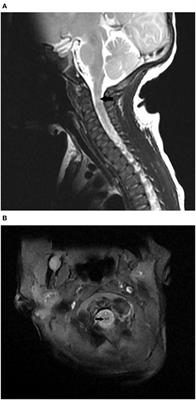 Unusual Presentations of Birth Related Cervical Spinal Cord Injury